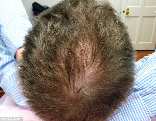 regrowing hair on a bald scalp